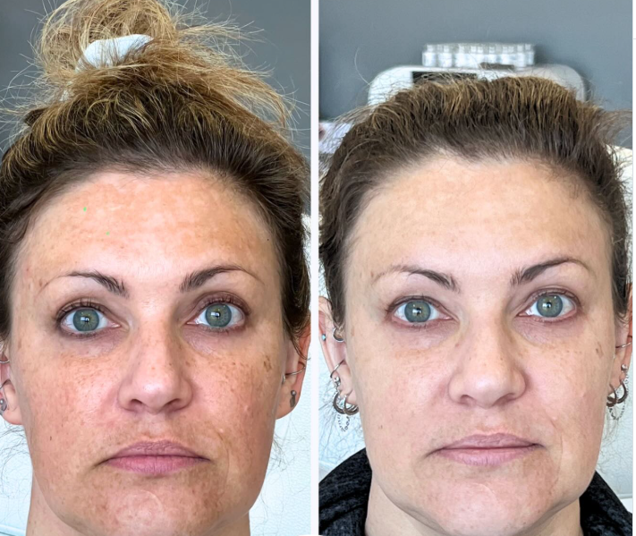 Improved melasma and brighter, more even skin after a 6-month treatment plan including peels, microneedling, and medical-grade skincare products.